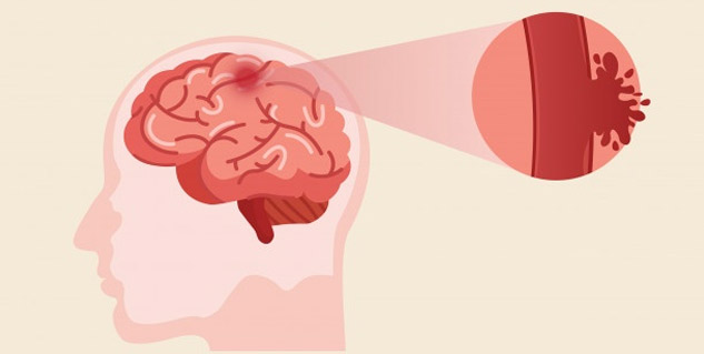 Stroke is of three kinds