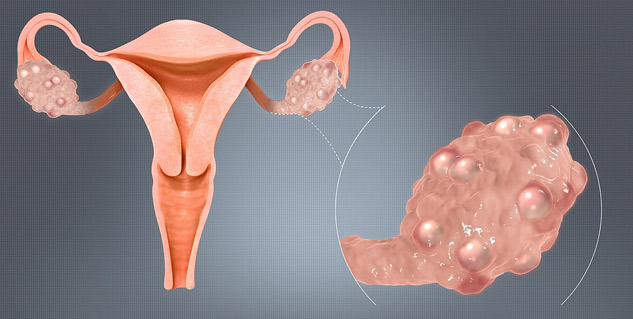 polycystic_ovary_syndrome