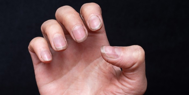 Osteoporosis in Young Women signs