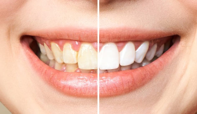 inside2teethremedies