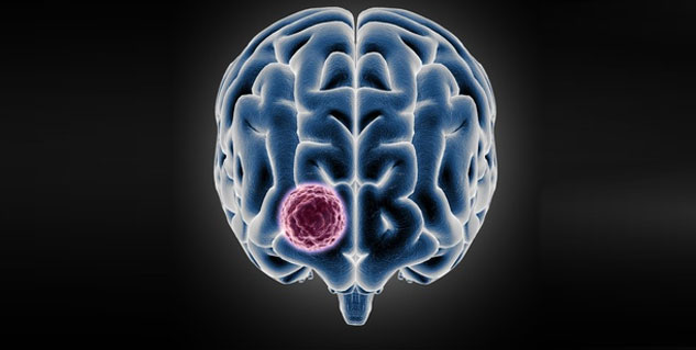 Brain tumour can be benign or malignant