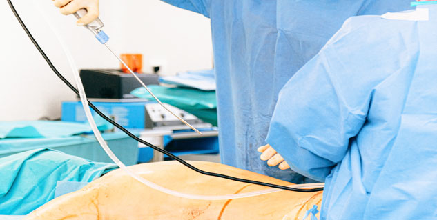 Laser Surgery