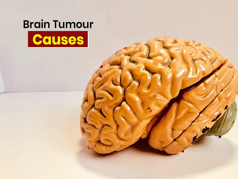 What Causes Brain Tumour? Know Symptoms, Treatment Options From Expert
