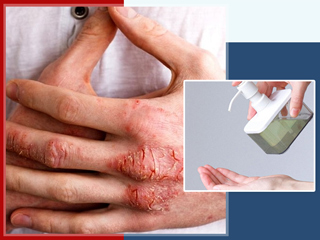 Can Frequent Hand Washing Lead To Eczema & Flare-Ups? Know Tips To Prevent It
