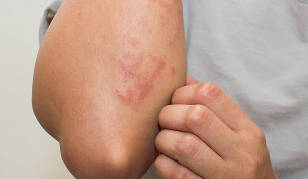 rashes on skin
