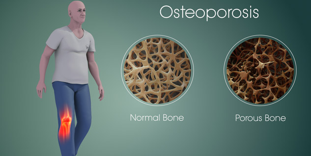 osteoporosis