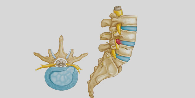 herniated_spine