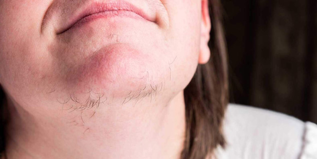 hair on chin