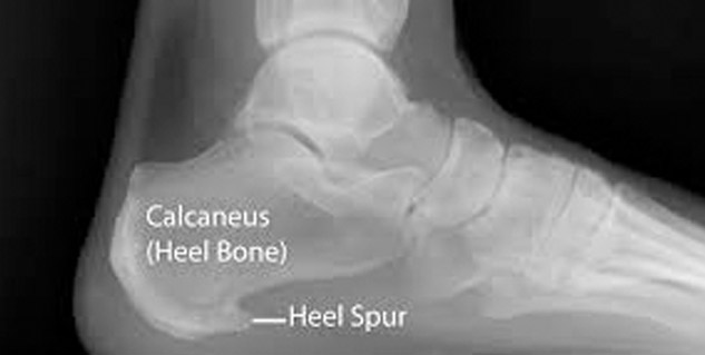 x-ray_of_bone_spur