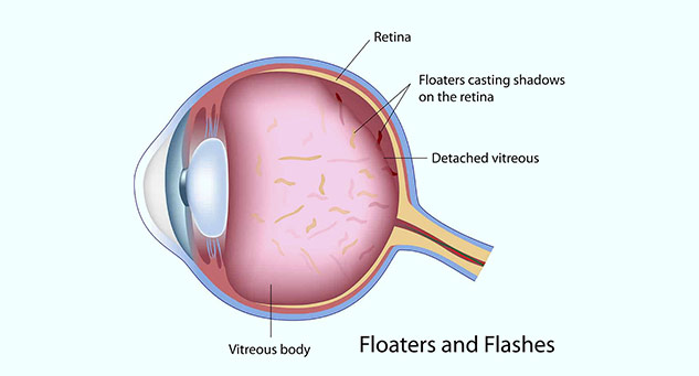 eye_floater_problem_eyesight