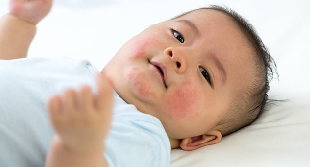 skin allergy in children