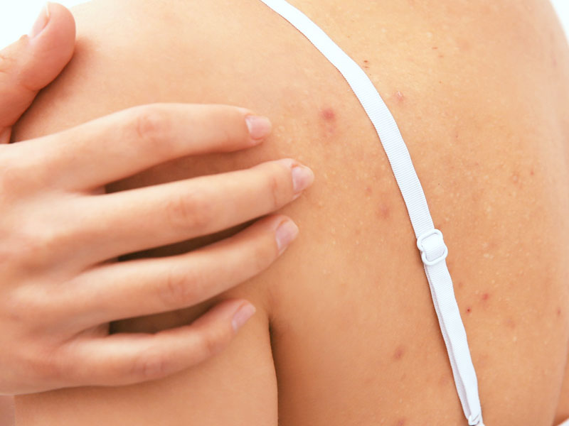 Try These 7 Simple Home Remedies To Treat Body Acne