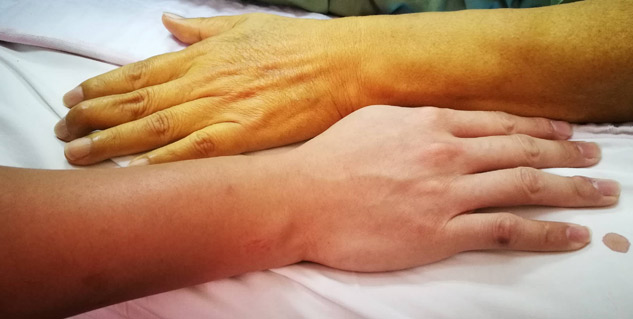 difference_between_jaundice_and_normal_skin