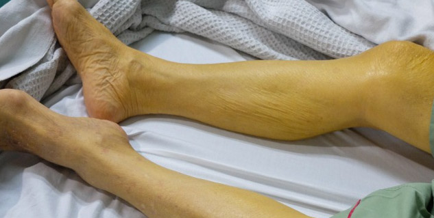 symptoms_of_jaundice