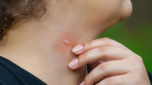 insect bite