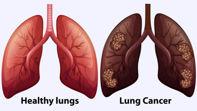 lung cancer