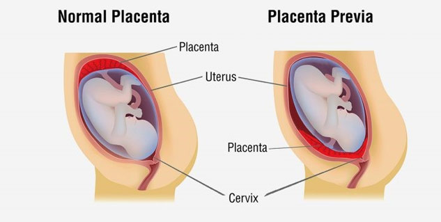 placenta previa