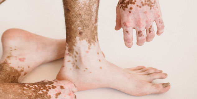 eczema_psoriasis