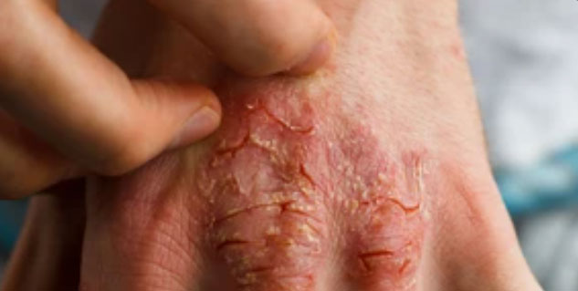 psoriasis_cracked_skin
