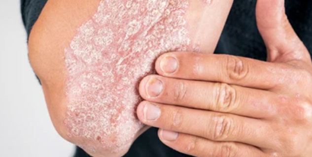 psoriaisis_in_hands