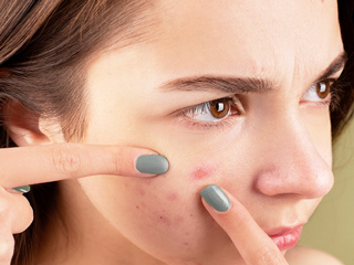 9 Home Remedies For Popped Pimples And Redness On Skin