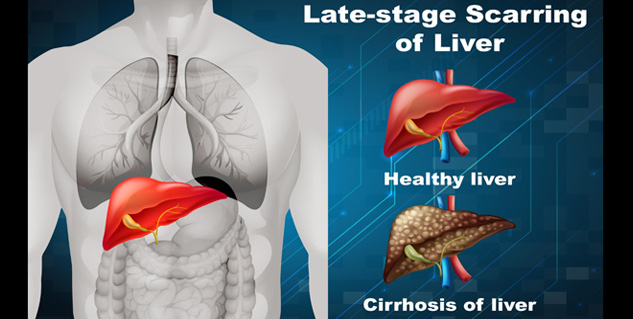 Liver Disease