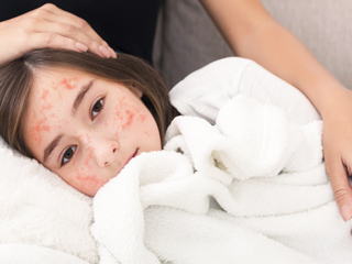 9 Ways To Cure Measles Skin Infection Naturally