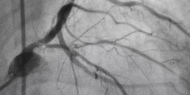 Heart Vein Blockage