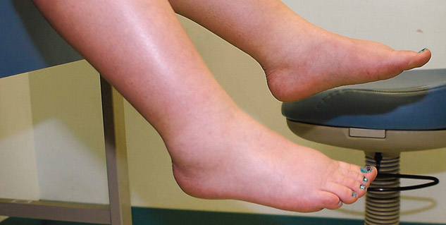 edema symptoms