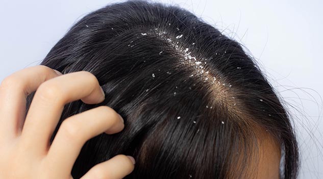 dandruff