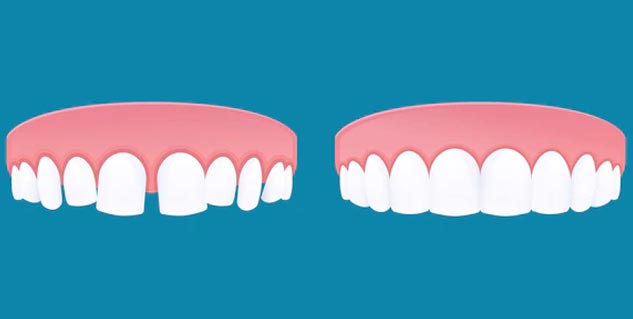 What Causes Gaps Between Teeth Causes And Treatment OnlyMyHealth