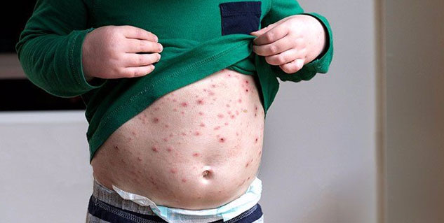 chickenpox_symptoms