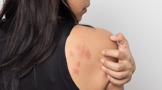 skin rashes fever in hindi