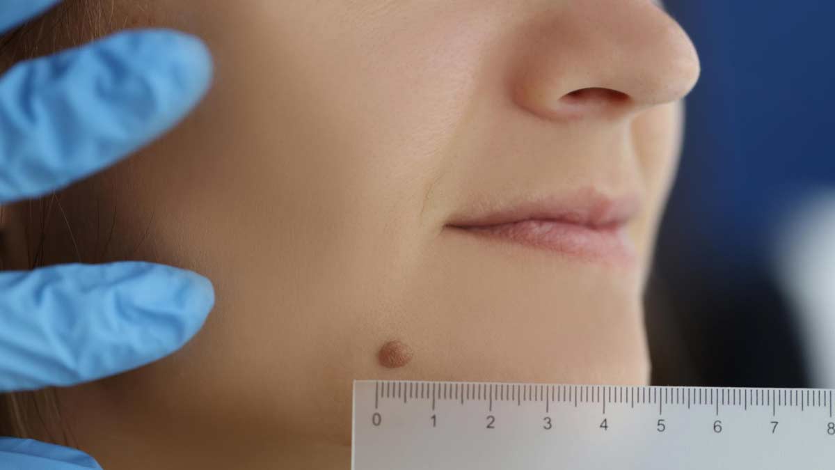 moles removal on face