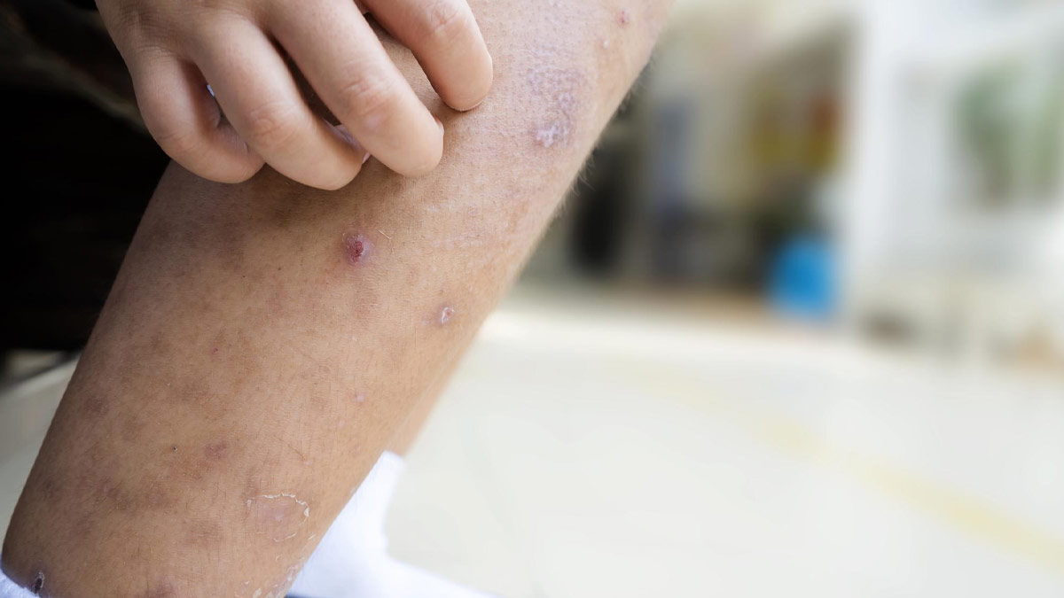 ow To Remove Mosquito Bite Scars Home Remedies In Hindi