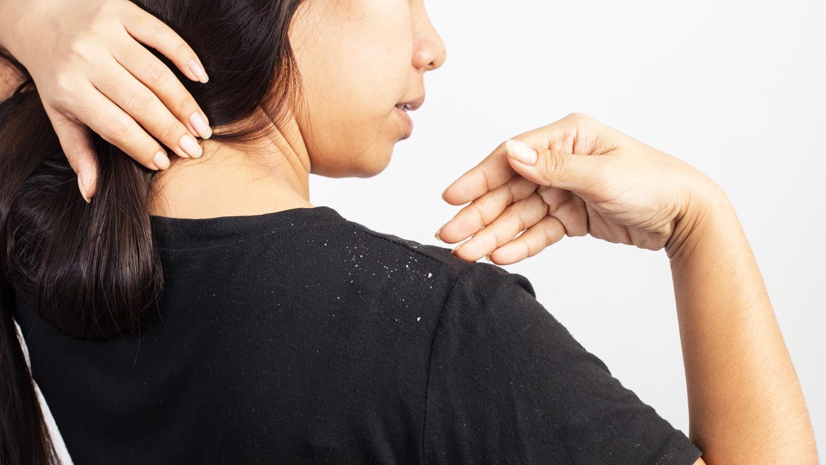 oil for dandruff