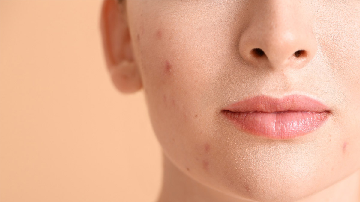 Benefits Of Cumin Powder For Pimples