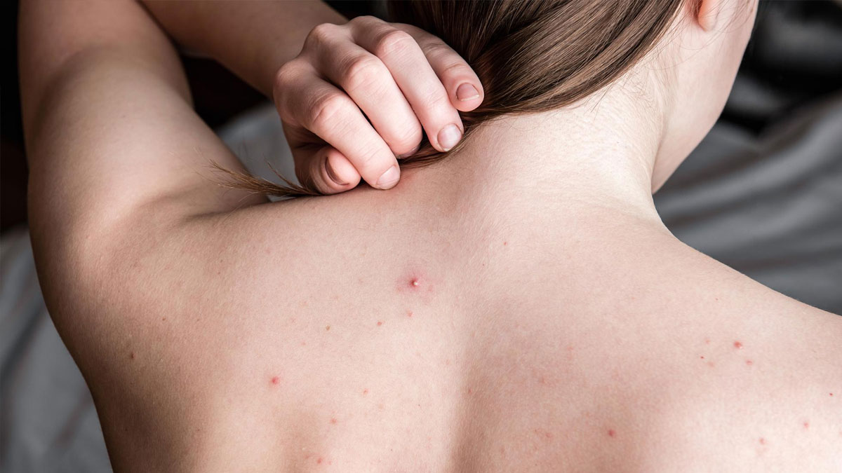 Back Acne Reasons in Hindi
