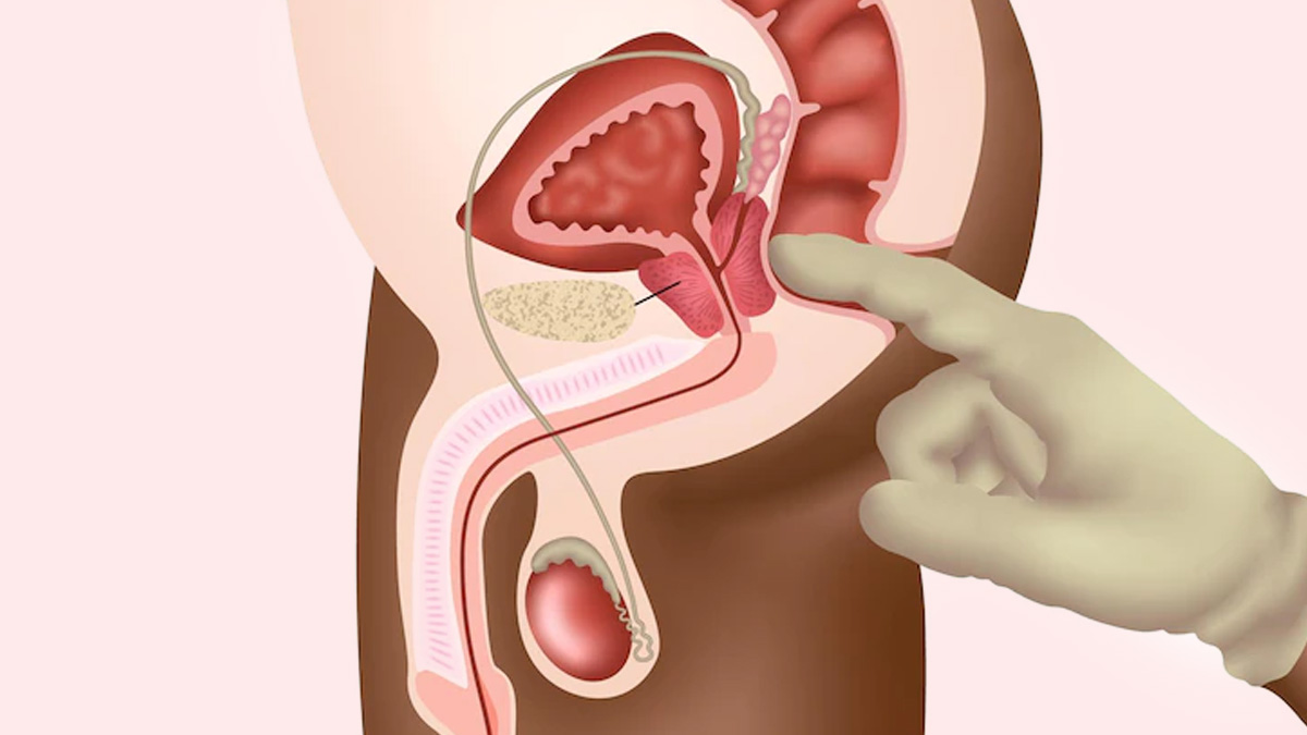 Colorectal Cancer: Signs And Dietary Changes To Reduce The Risk Of It