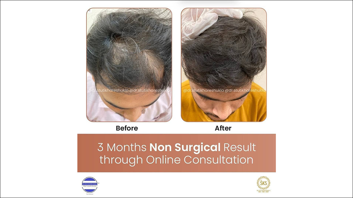 Non Surgical Hair Growth Solution