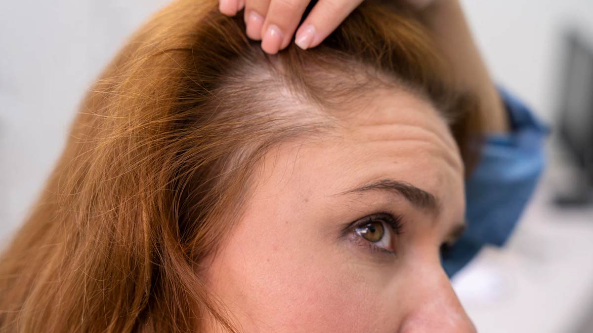 Causes Symptoms Types And Treatment For Female Pattern Baldness