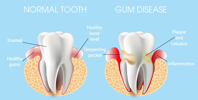 Gingiva