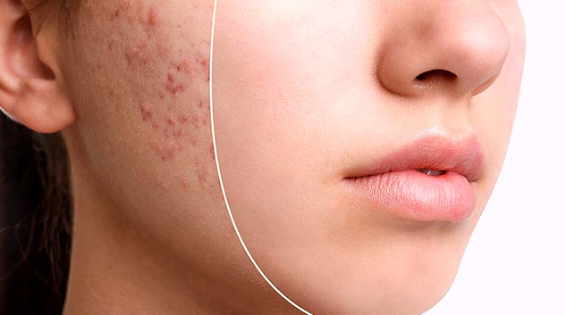 insideacne