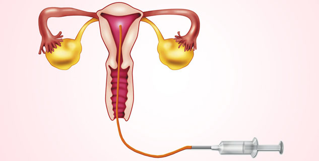 IUI