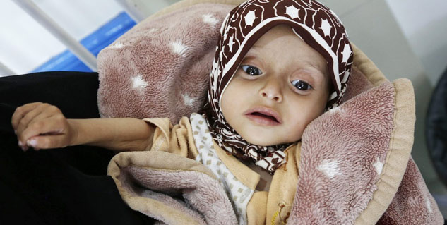 malnutrition in kids