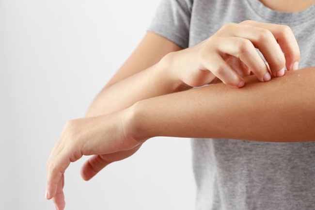 Natural ways to prevent psoriasis