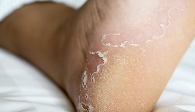 Peeling skin