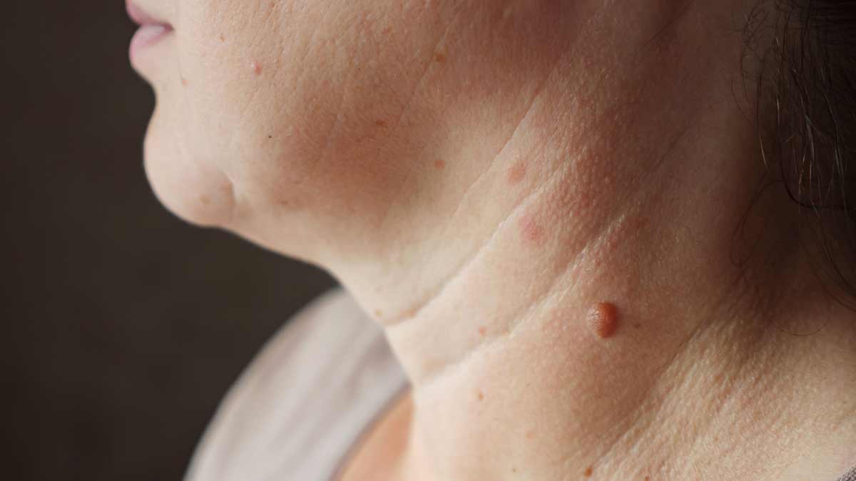 Warts on Neck Causes Home Remedies