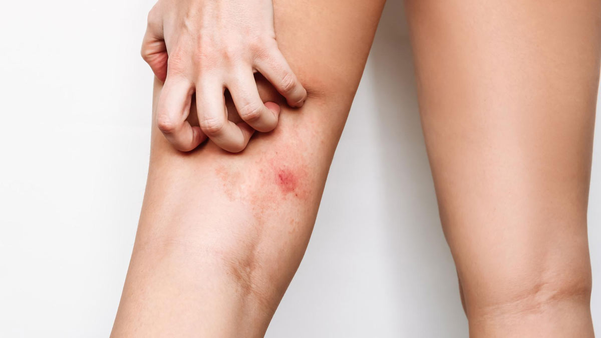 Home Remedies For Itching In Thighs Hindi