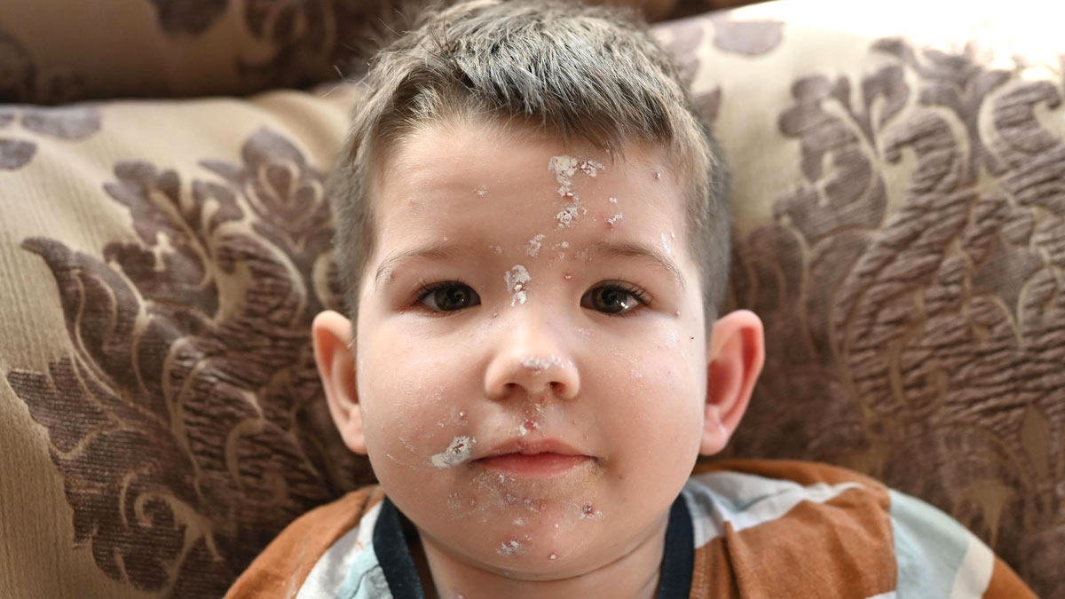 impetigo